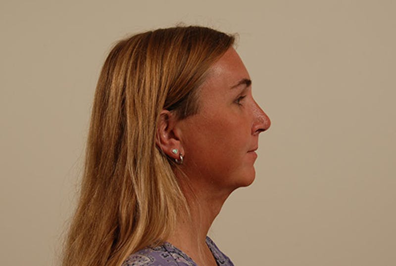 Facial Feminization Before & After Gallery - Patient 120905587 - Image 6