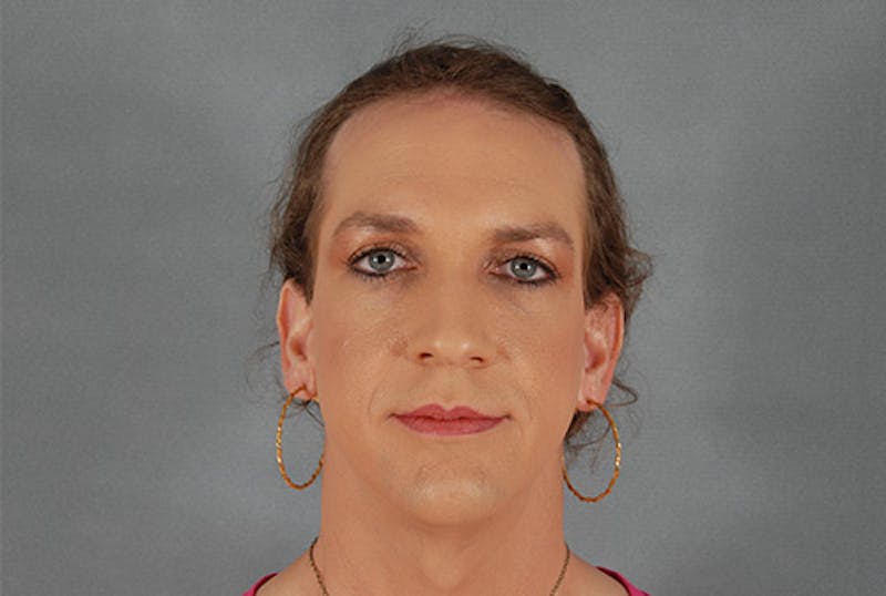 Facial Feminization Before & After Gallery - Patient 120905591 - Image 1
