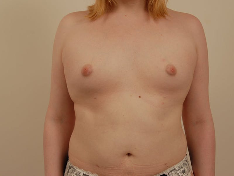 Breast Augmentation Before & After Gallery - Patient 120905592 - Image 1