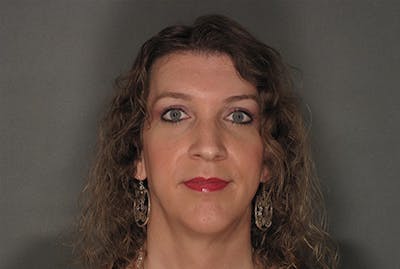 Facial Feminization Before & After Gallery - Patient 120905591 - Image 2
