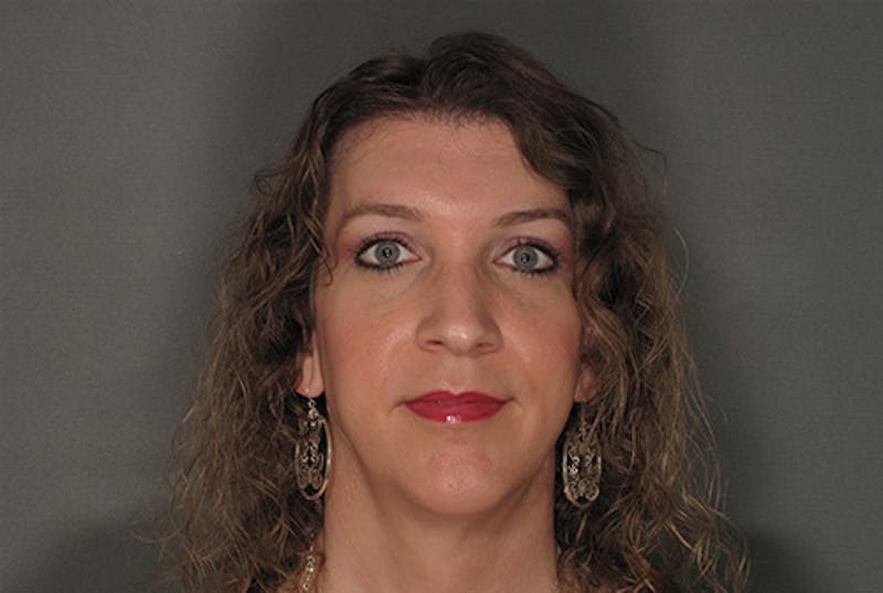 Facial Feminization Before & After Gallery - Patient 120905591 - Image 2