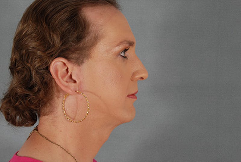 Facial Feminization Before & After Gallery - Patient 120905591 - Image 3