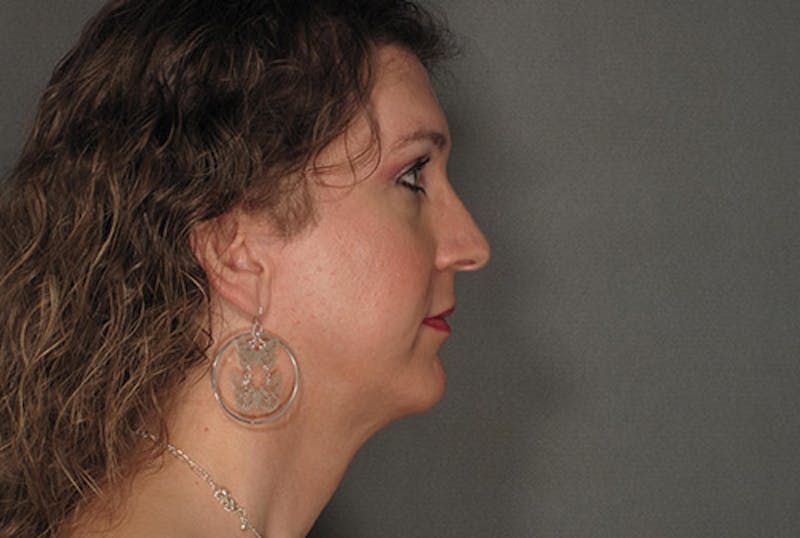 Facial Feminization Before & After Gallery - Patient 120905591 - Image 4