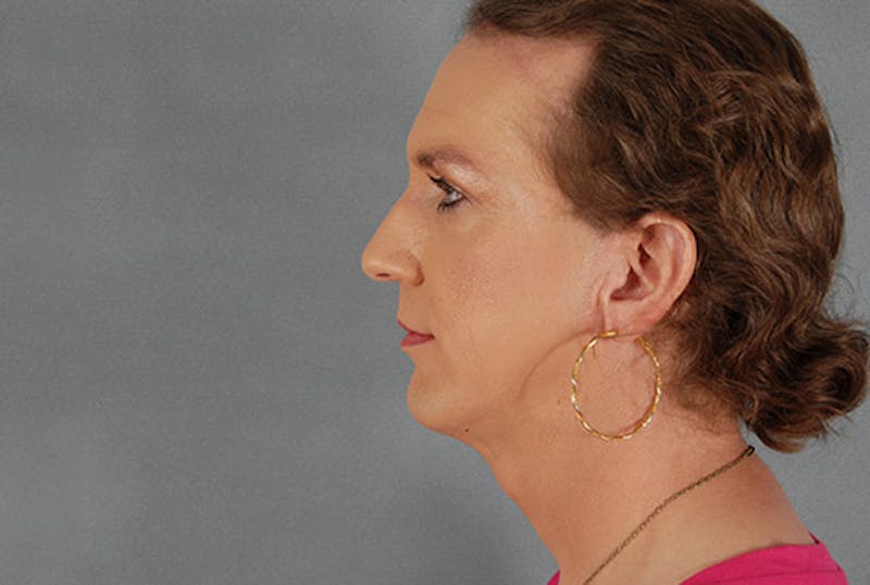 Facial Feminization Before & After Gallery - Patient 120905591 - Image 5