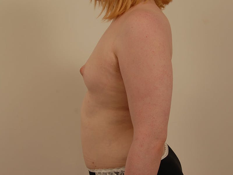 Breast Augmentation Before & After Gallery - Patient 120905592 - Image 5