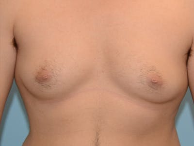 Top Surgery Before & After Gallery - Patient 120905593 - Image 1