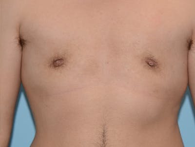 Top Surgery Before & After Gallery - Patient 120905593 - Image 2