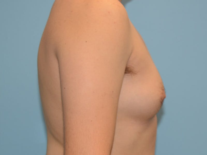 Top Surgery Before & After Gallery - Patient 120905593 - Image 3