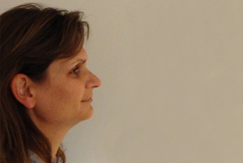 Facial Feminization Before & After Gallery - Patient 120905594 - Image 3