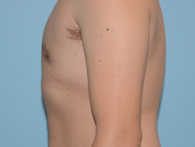 Top Surgery Before & After Gallery - Patient 120905593 - Image 6