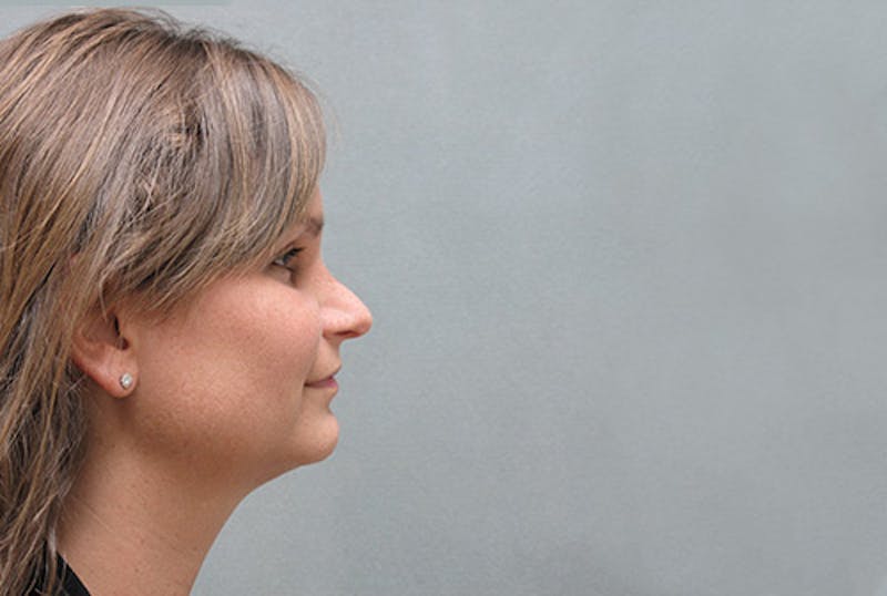 Facial Feminization Before & After Gallery - Patient 120905594 - Image 4