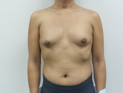 隆胸前后图库-患者120905624 -图1