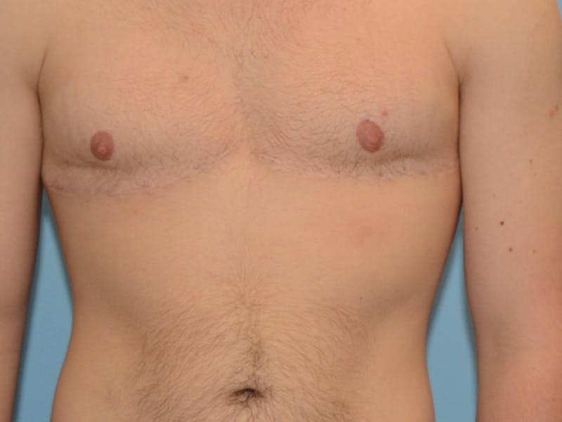 Top Surgery Before & After Gallery - Patient 120905618 - Image 2