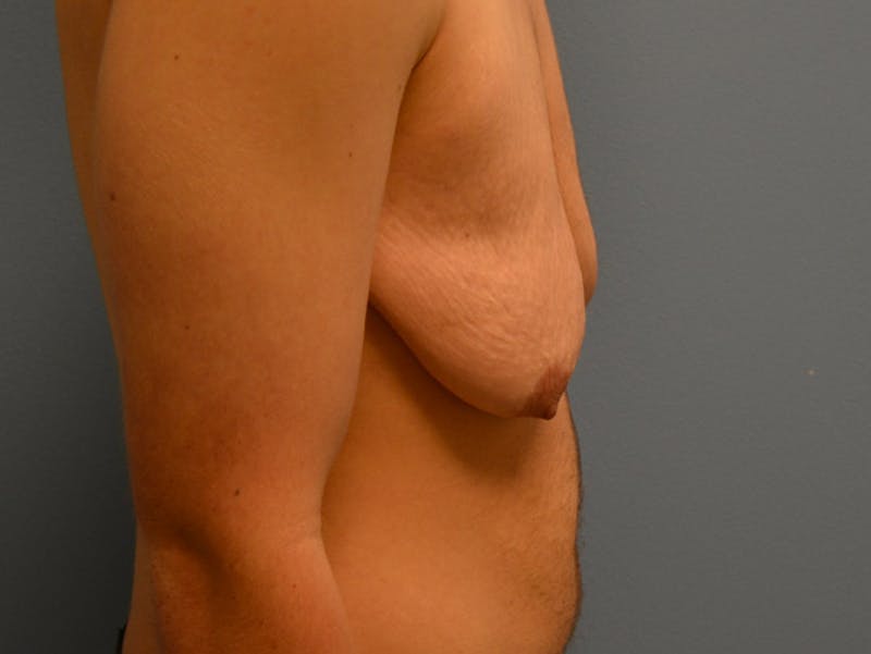 Top Surgery Before & After Gallery - Patient 120905618 - Image 3