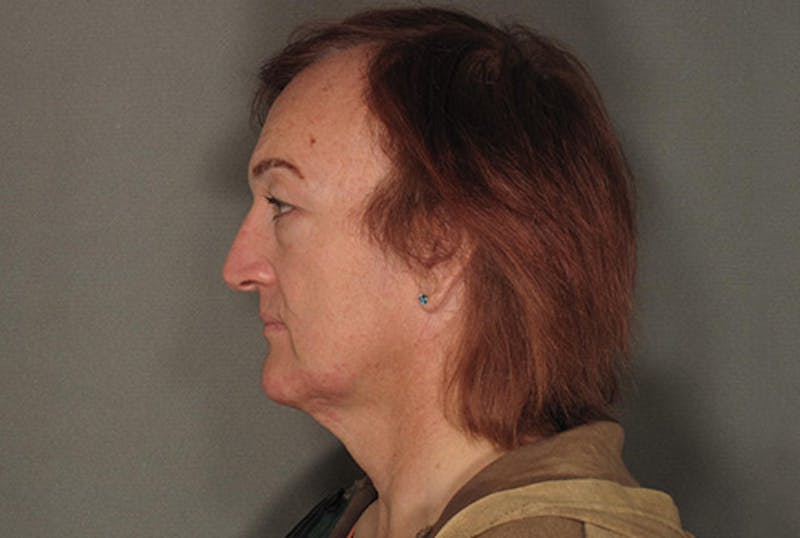Facial Feminization Before & After Gallery - Patient 120905620 - Image 3