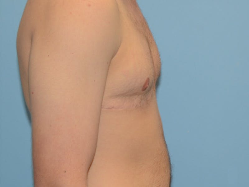 Top Surgery Before & After Gallery - Patient 120905618 - Image 4