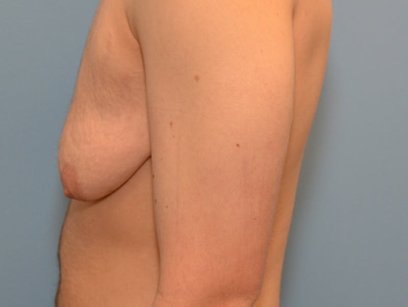 Top Surgery Before & After Gallery - Patient 120905618 - Image 5