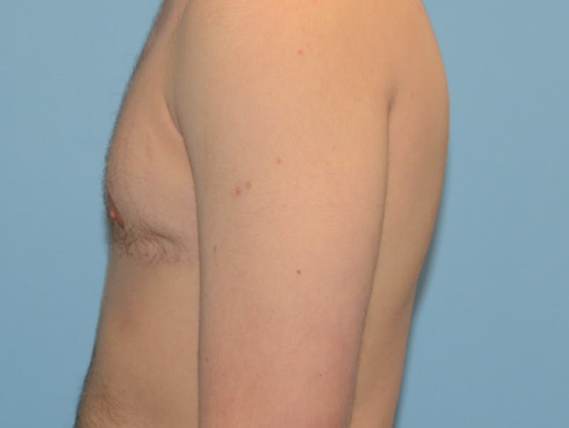 Top Surgery Before & After Gallery - Patient 120905618 - Image 6