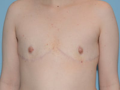 Top Surgery Before & After Gallery - Patient 120905627 - Image 2