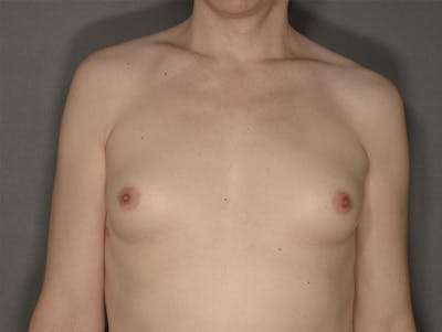 隆胸前后图库-患者120905632 -图1