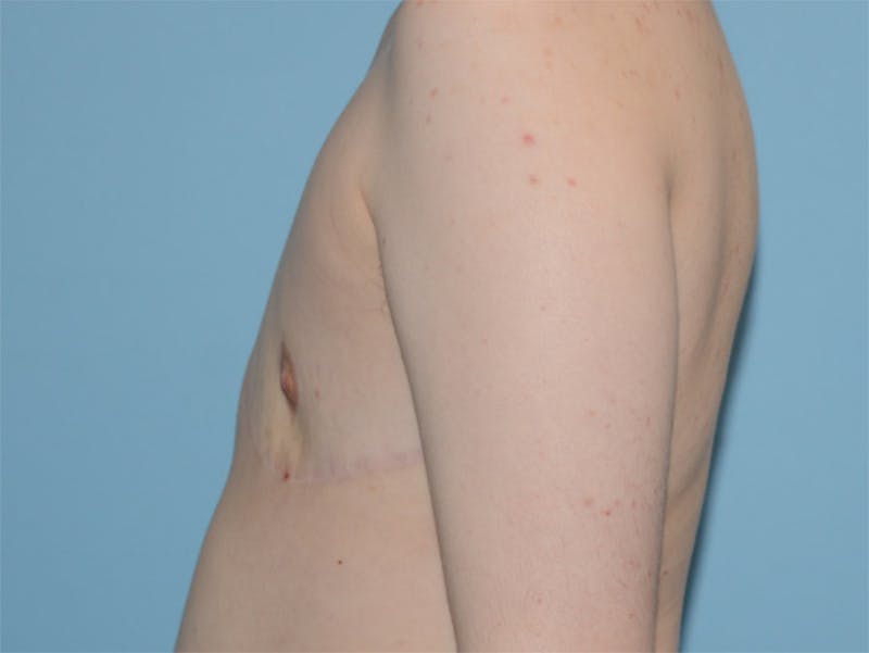 Top Surgery Before & After Gallery - Patient 120905627 - Image 4