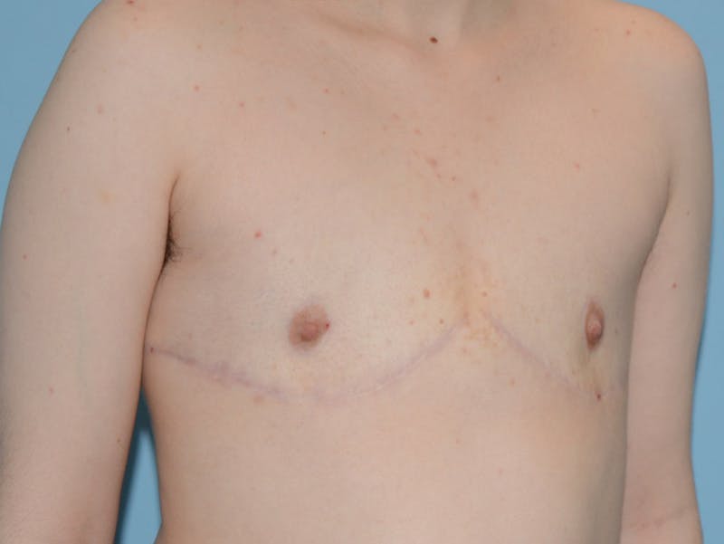 Top Surgery Before & After Gallery - Patient 120905627 - Image 6
