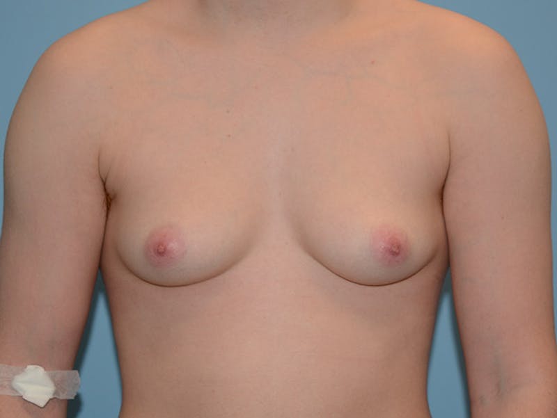 Top Surgery Before & After Gallery - Patient 120905631 - Image 1