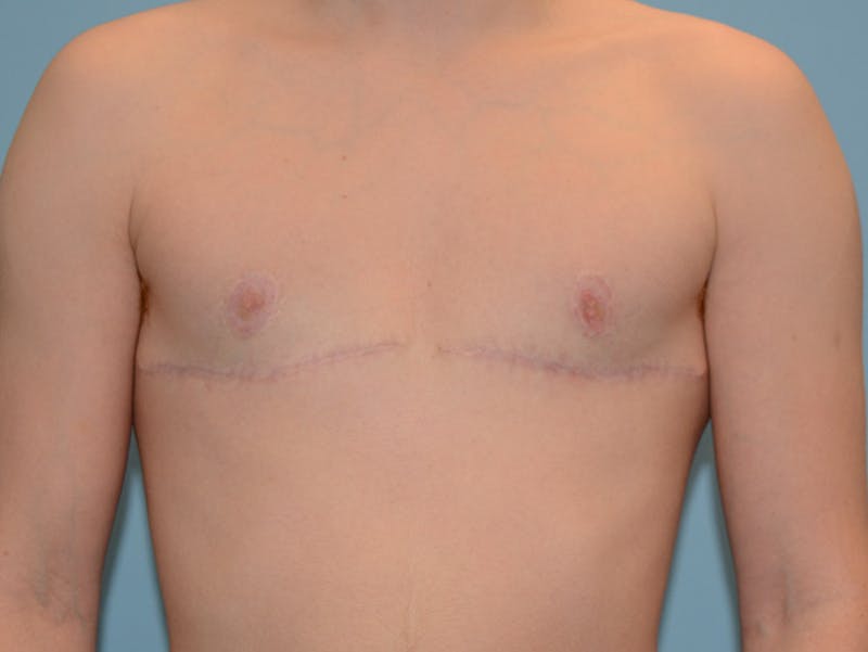 Top Surgery Before & After Gallery - Patient 120905631 - Image 2