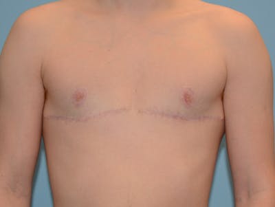 Top Surgery Before & After Gallery - Patient 120905631 - Image 2