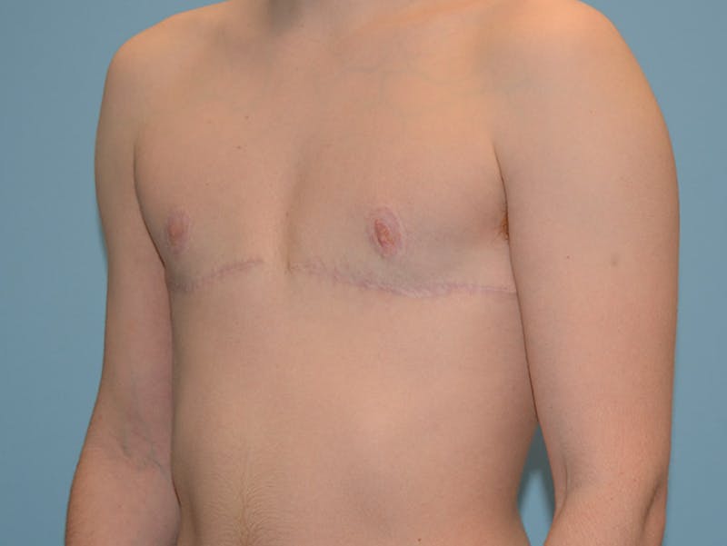 Top Surgery Before & After Gallery - Patient 120905631 - Image 4