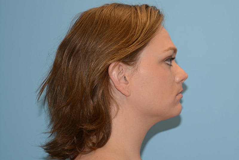 Facial Feminization Gallery - Patient 120905633 - Image 3