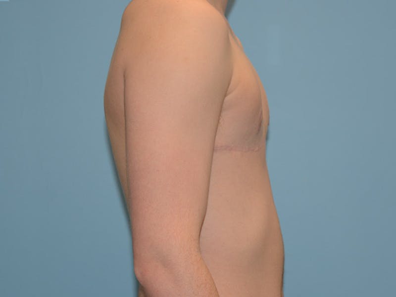 Top Surgery Before & After Gallery - Patient 120905631 - Image 6