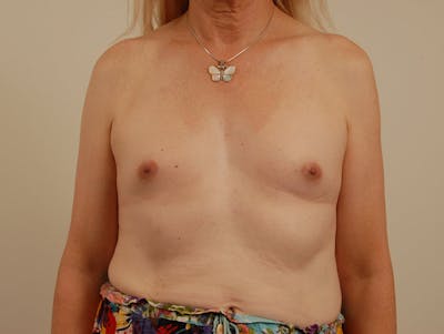 隆胸前后图库-病人120905635 -图片1