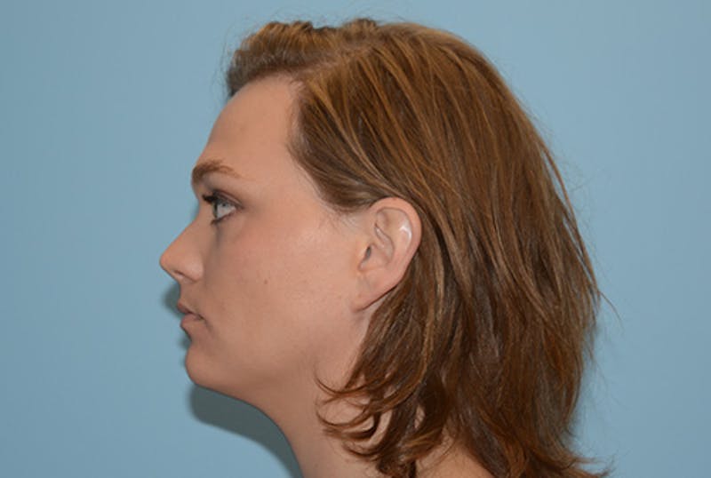 Facial Feminization Before & After Gallery - Patient 120905633 - Image 7