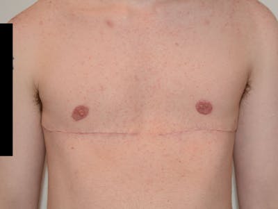 Top Surgery Before & After Gallery - Patient 120905634 - Image 2