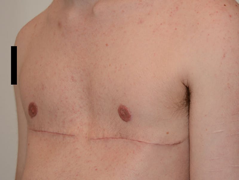 Top Surgery Before & After Gallery - Patient 120905634 - Image 4