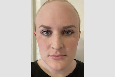 Facial Feminization Before & After Gallery - Patient 120905638 - Image 1