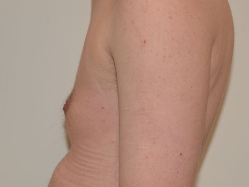 Top Surgery Before & After Gallery - Patient 120905634 - Image 5