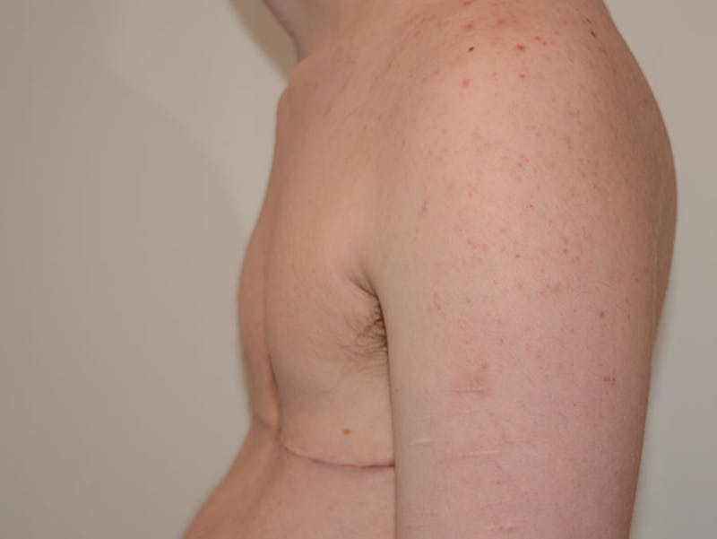 Top Surgery Before & After Gallery - Patient 120905634 - Image 6