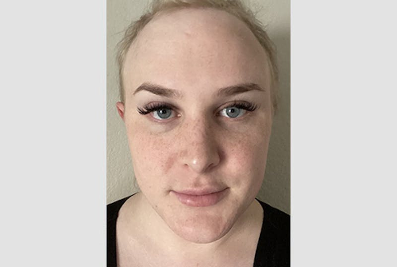 Facial Feminization Before & After Gallery - Patient 120905638 - Image 2