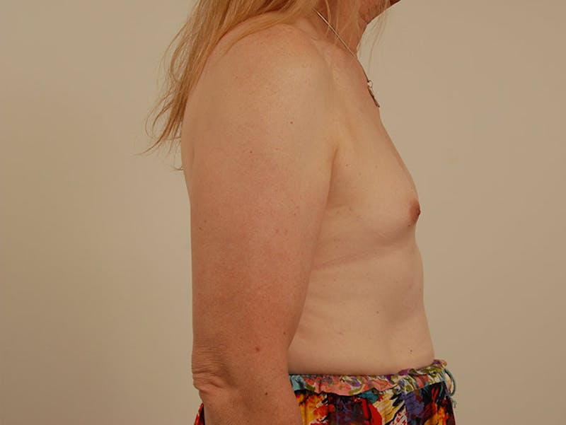 Breast Augmentation Before & After Gallery - Patient 120905635 - Image 5