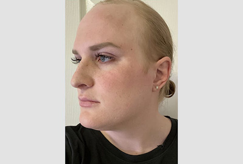 Facial Feminization Before & After Gallery - Patient 120905638 - Image 3
