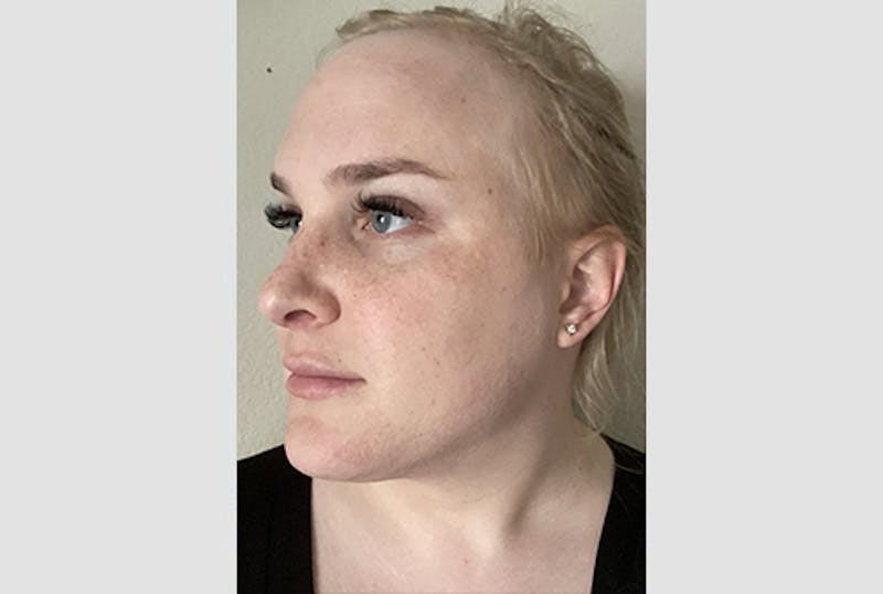 Facial Feminization Before & After Gallery - Patient 120905638 - Image 4