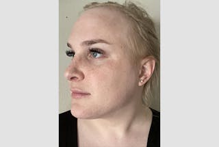 Facial Feminization Before & After Gallery - Patient 120905638 - Image 4