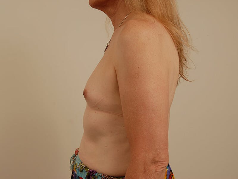 Breast Augmentation Gallery - Patient 120905635 - Image 7