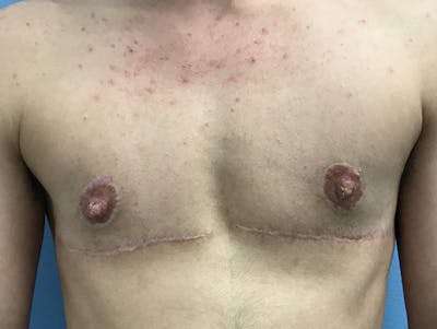 Top Surgery Before & After Gallery - Patient 120905647 - Image 2