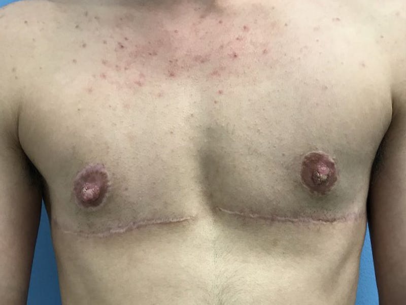 Top Surgery Before & After Gallery - Patient 120905647 - Image 2