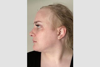 Facial Feminization Before & After Gallery - Patient 120905638 - Image 6