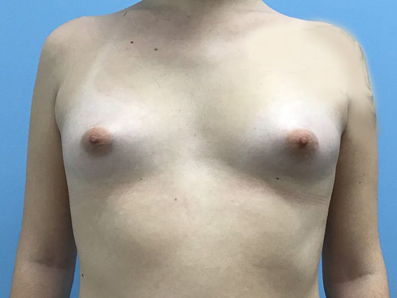 Breast Augmentation Before & After Gallery - Patient 120905652 - Image 1