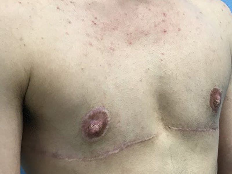 Top Surgery Before & After Gallery - Patient 120905647 - Image 4